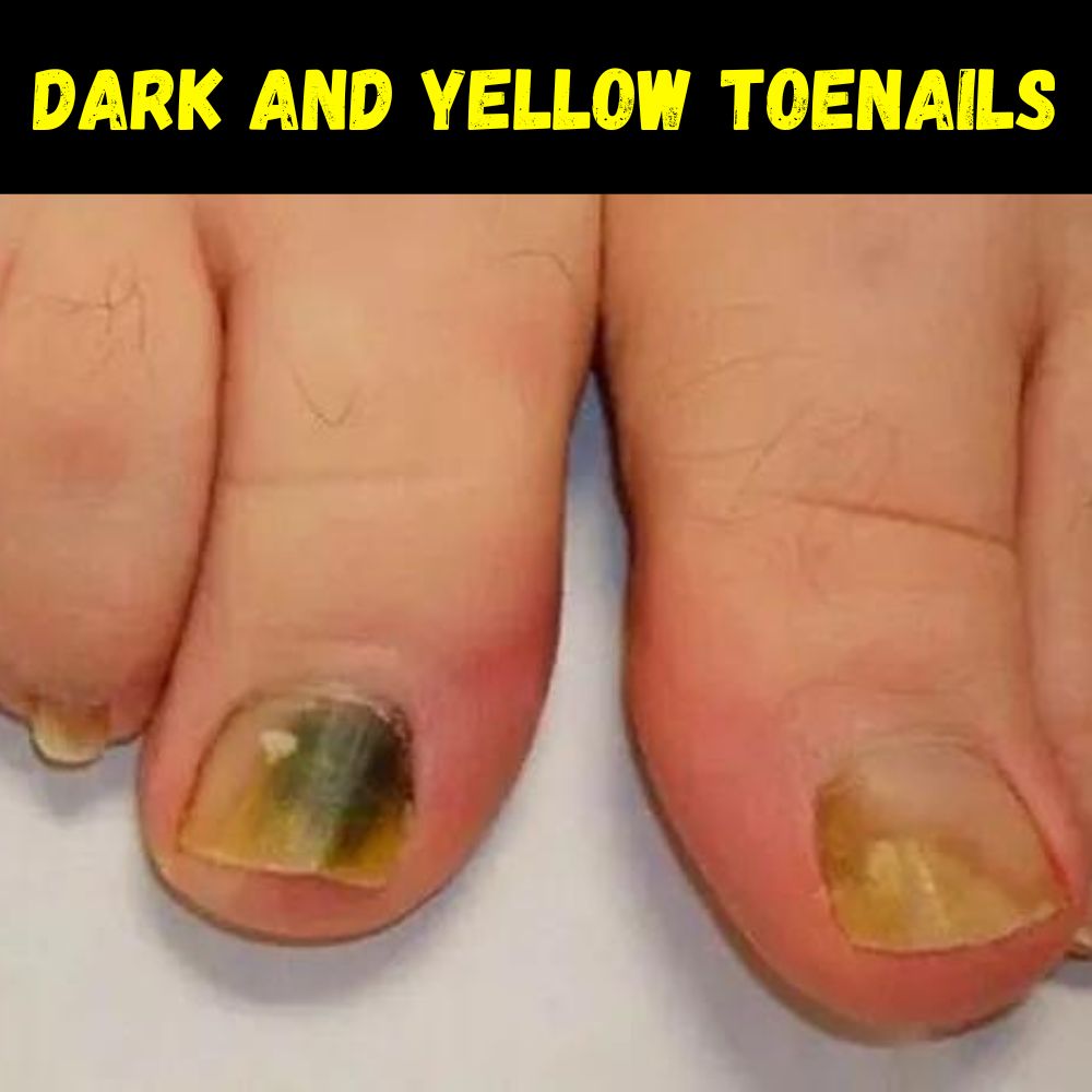 Dark and yellow toenails